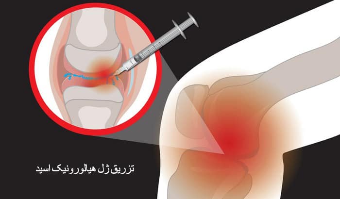 تزریق ژل هیالورونیک اسید برای درمان آرتروز
